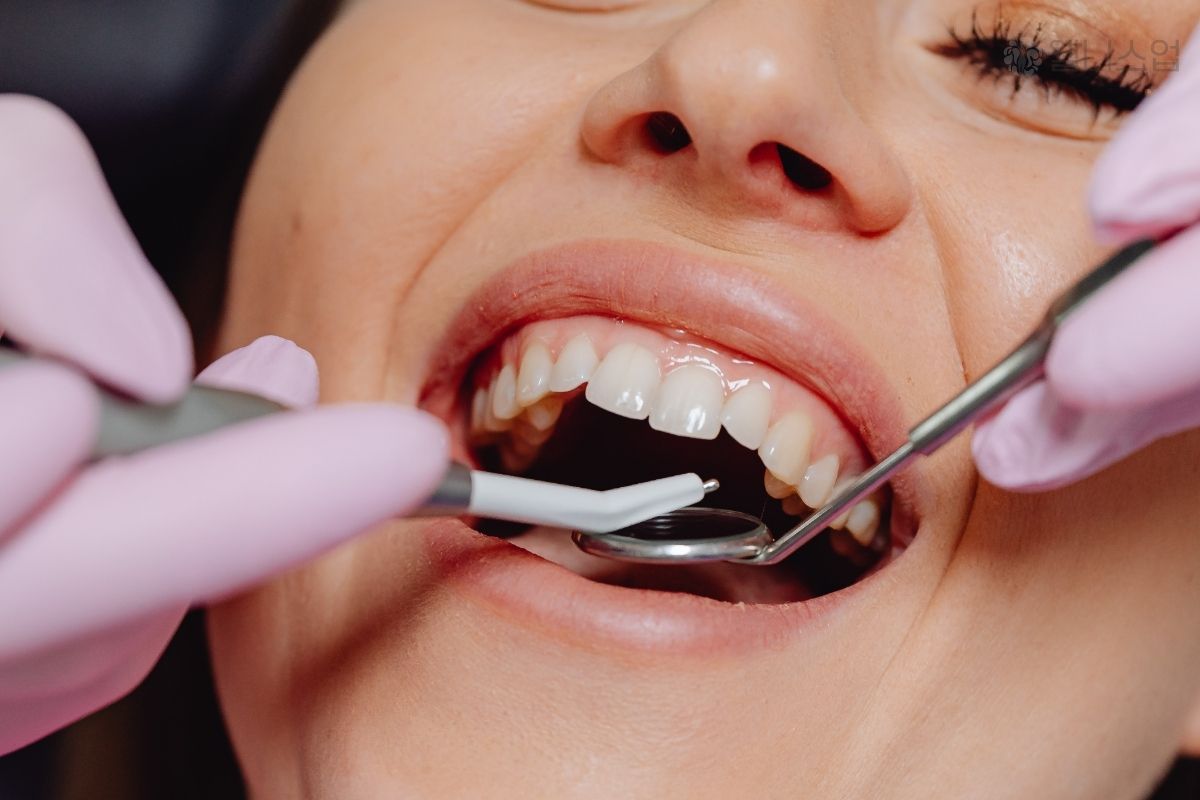 NIỀNG RĂNG KHỚP CẮN NGƯỢC